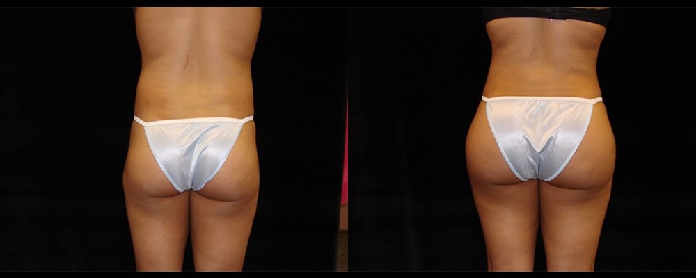 Brazilian Butt Lift Before & After Patient #728