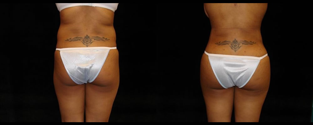 Brazilian Butt Lift Before & After Patient #724