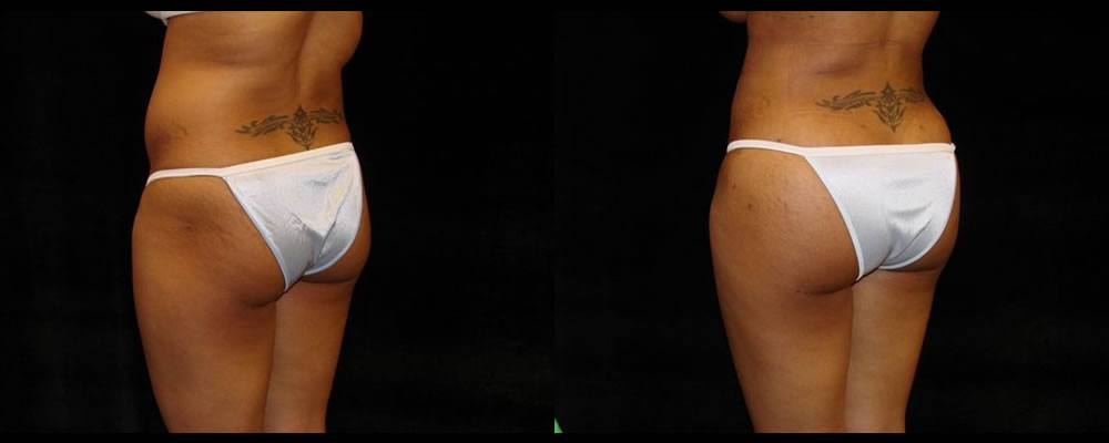 Brazilian Butt Lift Before & After Patient #724