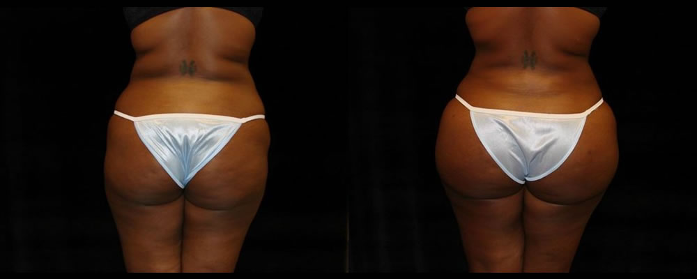 Brazilian Butt Lift Before & After Patient #720