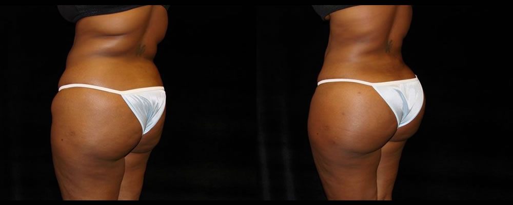 Brazilian Butt Lift Before & After Patient #720