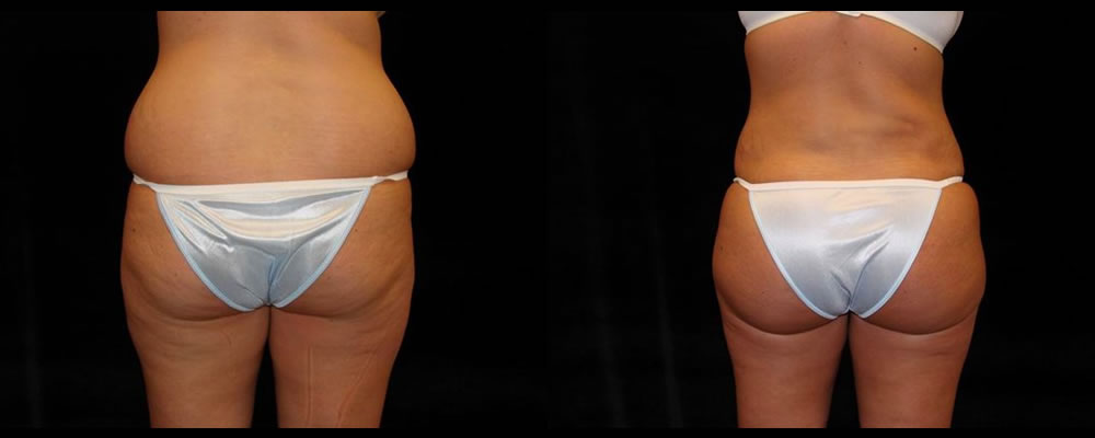 Brazilian Butt Lift Before & After Patient #713