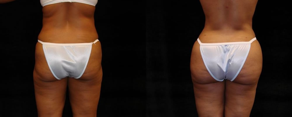 Brazilian Butt Lift Before & After Patient #709