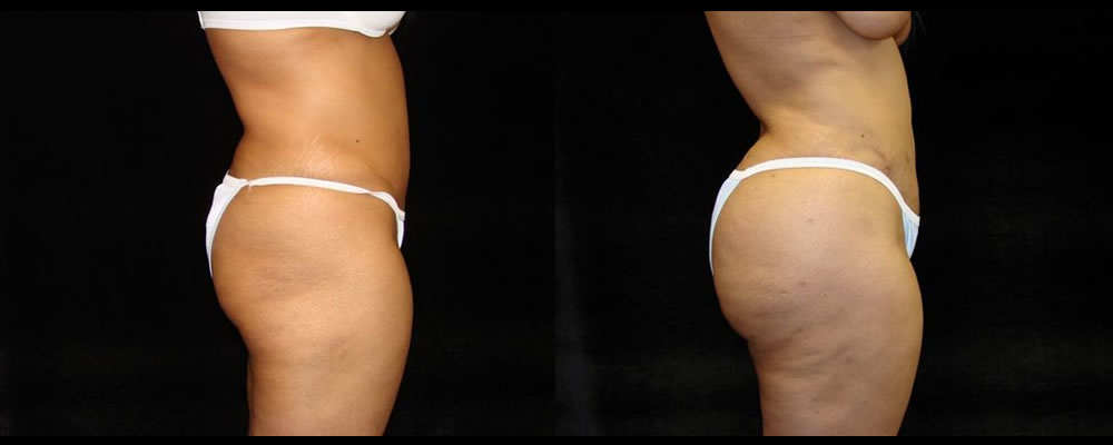 Brazilian Butt Lift Before & After Patient #709