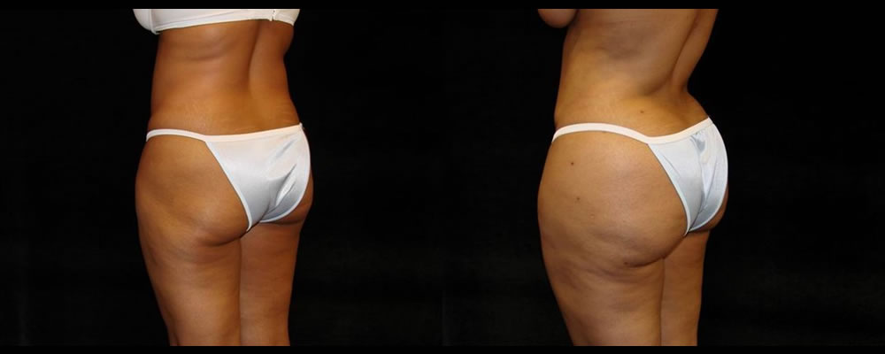 Brazilian Butt Lift Before & After Patient #709