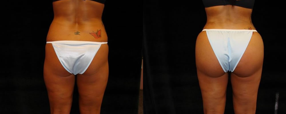 Brazilian Butt Lift Before & After Patient #775