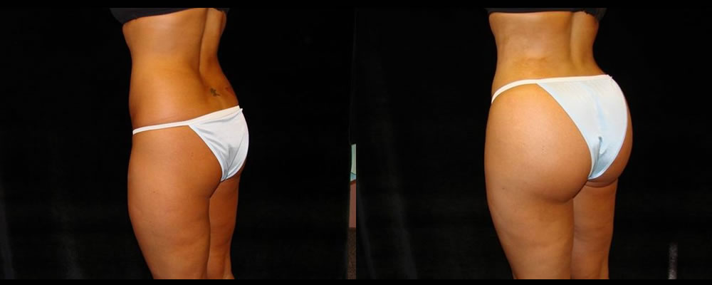 Brazilian Butt Lift Before & After Patient #775
