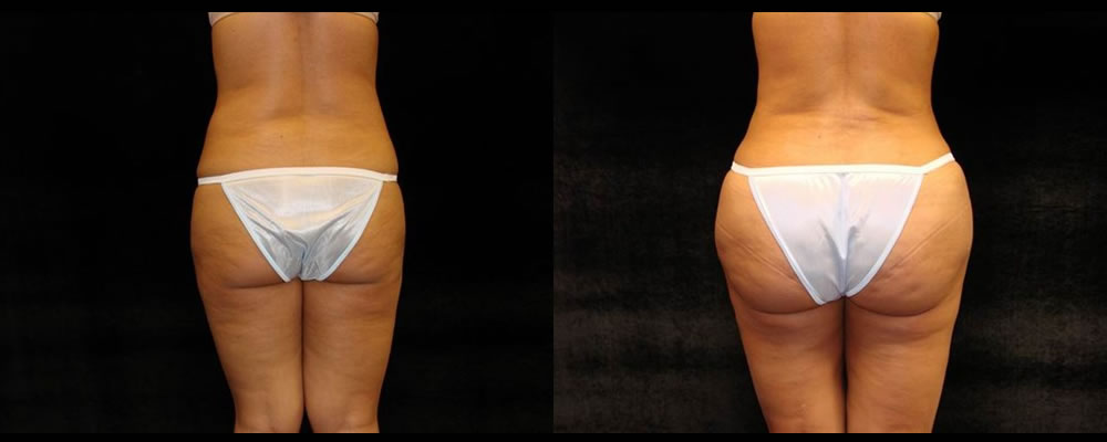 Brazilian Butt Lift Before & After Patient #705