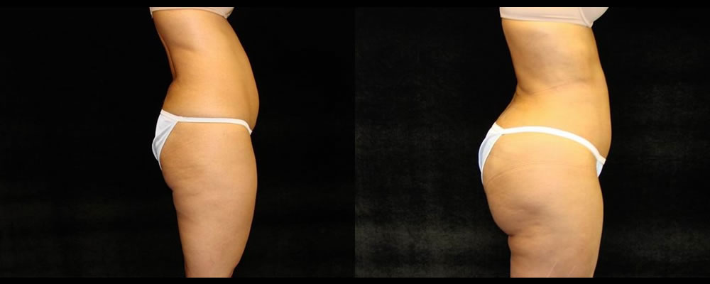 Brazilian Butt Lift Before & After Patient #705