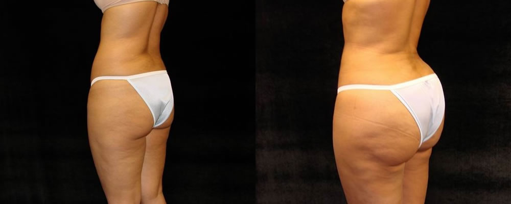 Brazilian Butt Lift Before & After Patient #705