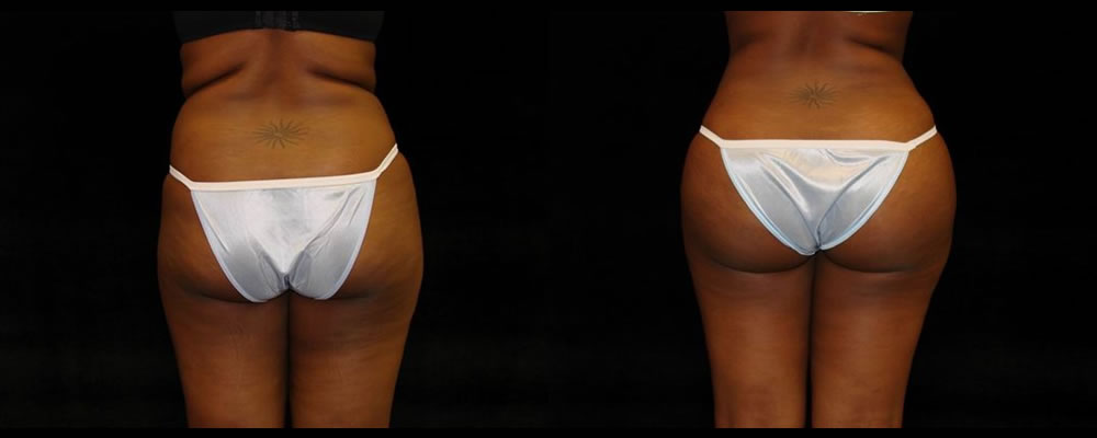 Brazilian Butt Lift Before & After Patient #701
