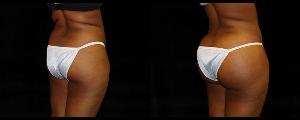 Brazilian Butt Lift Before & After Patient #701