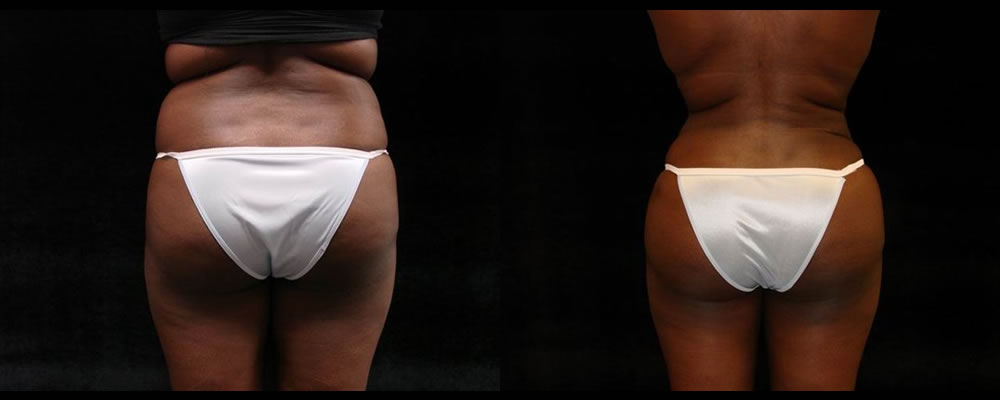 Brazilian Butt Lift Before & After Patient #697