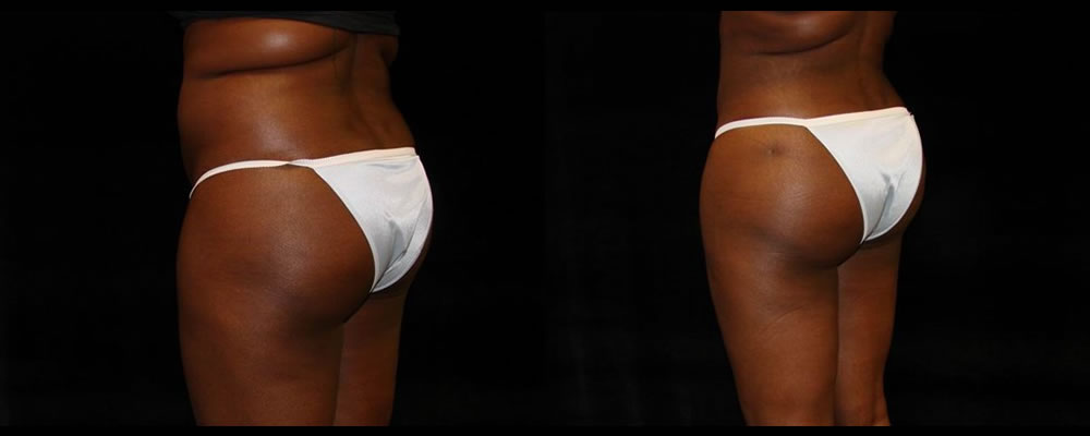 Brazilian Butt Lift Before & After Patient #697