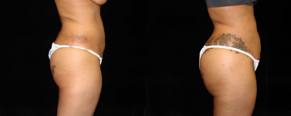 Brazilian Butt Lift Before & After Patient #690