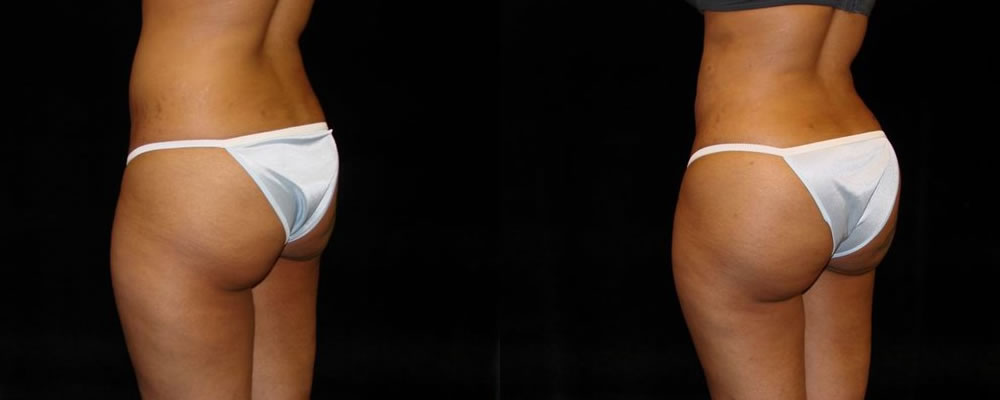 Brazilian Butt Lift Before & After Patient #690