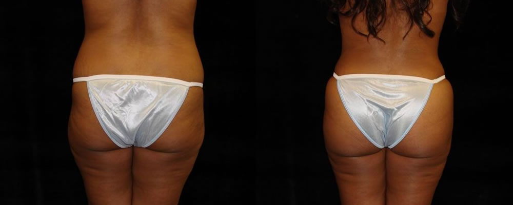 Brazilian Butt Lift Before & After Patient #686