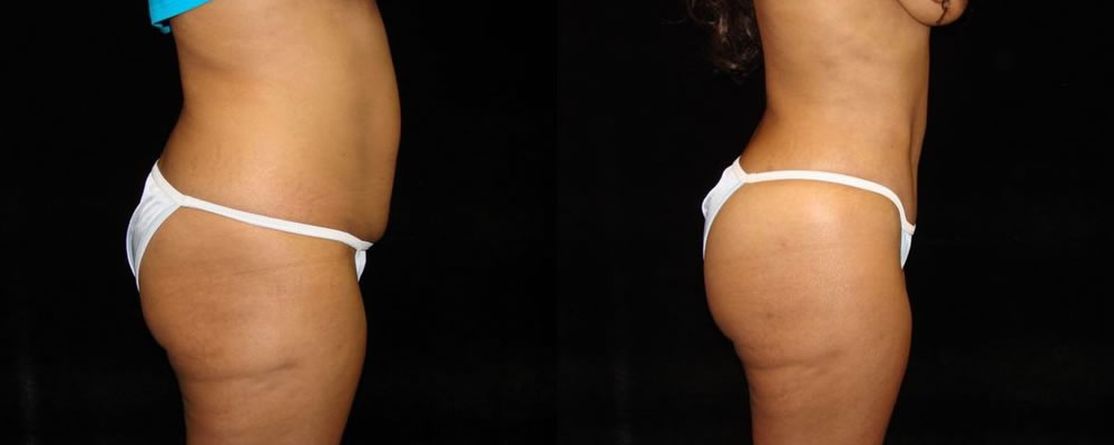 Brazilian Butt Lift Before & After Patient #686