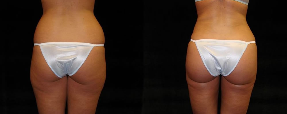 Brazilian Butt Lift Before & After Patient #682