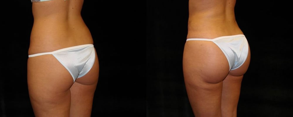 Brazilian Butt Lift Before & After Patient #682