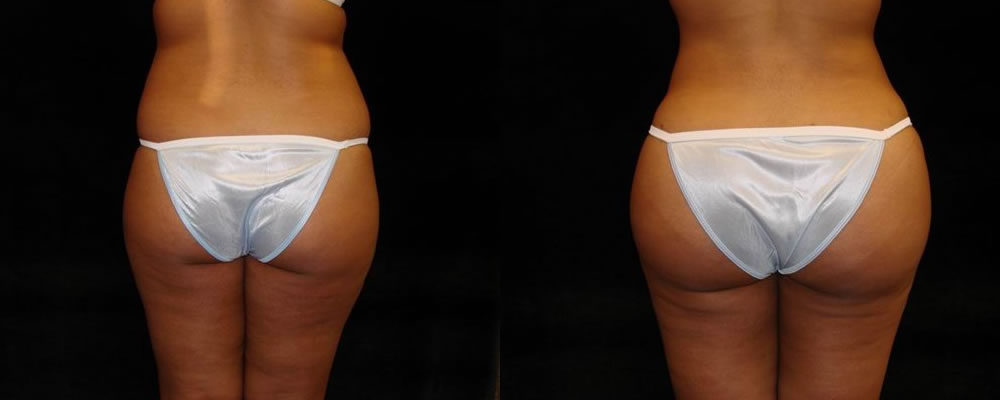 Brazilian Butt Lift Before & After Patient #678