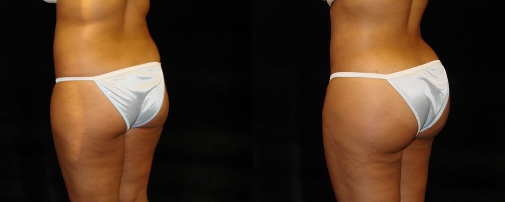 Brazilian Butt Lift Before & After Patient #678