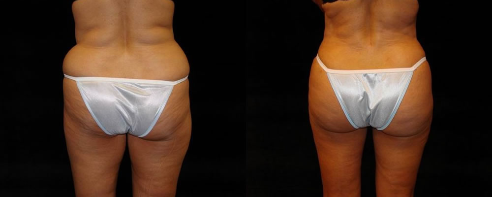Brazilian Butt Lift Before & After Patient #674