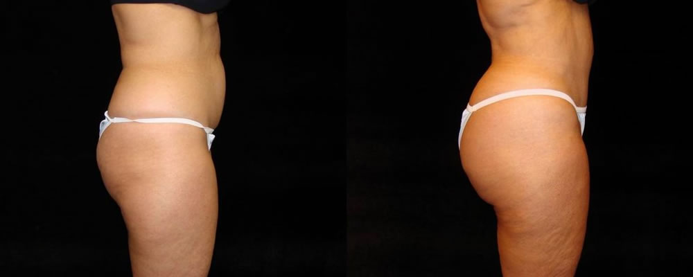 Brazilian Butt Lift Before & After Patient #674