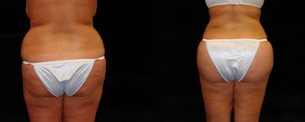 Brazilian Butt Lift Before & After Patient #670