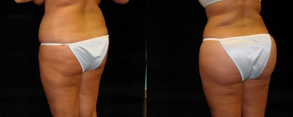 Brazilian Butt Lift Before & After Patient #670