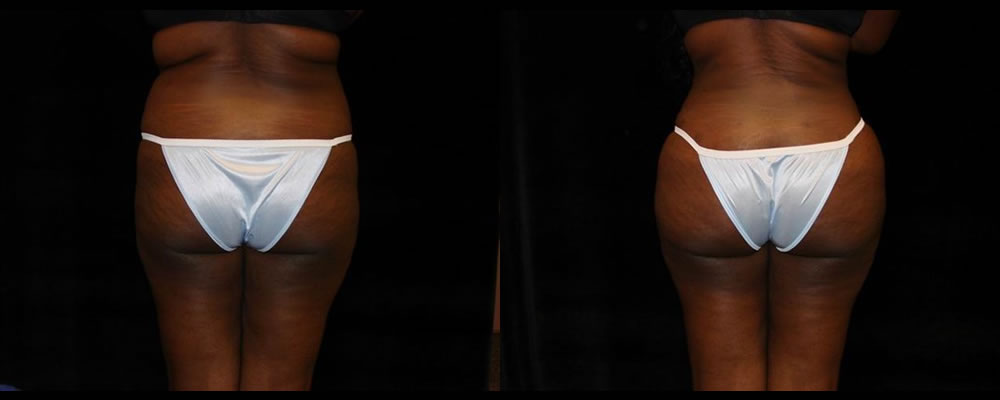 Brazilian Butt Lift Before & After Patient #771