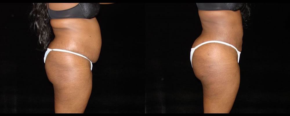 Brazilian Butt Lift Before & After Patient #771