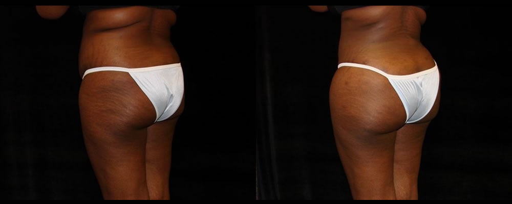 Brazilian Butt Lift Before & After Patient #771