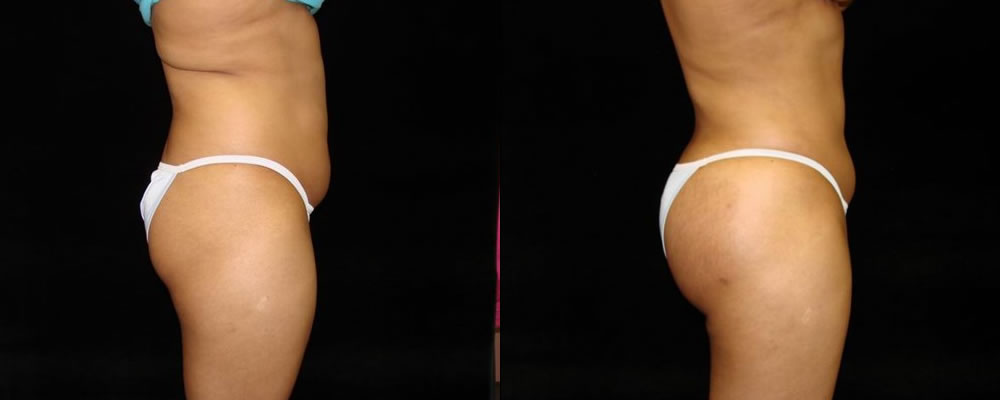 Brazilian Butt Lift Before & After Patient #666