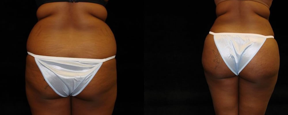 Brazilian Butt Lift Before & After Patient #662