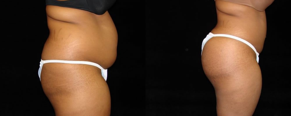 Brazilian Butt Lift Before & After Patient #662