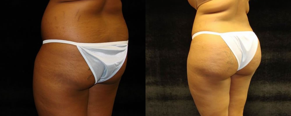 Brazilian Butt Lift Before & After Patient #662