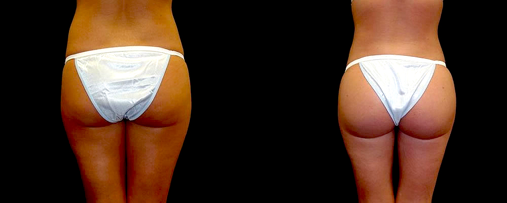 Brazilian Butt Lift Before & After Patient #658