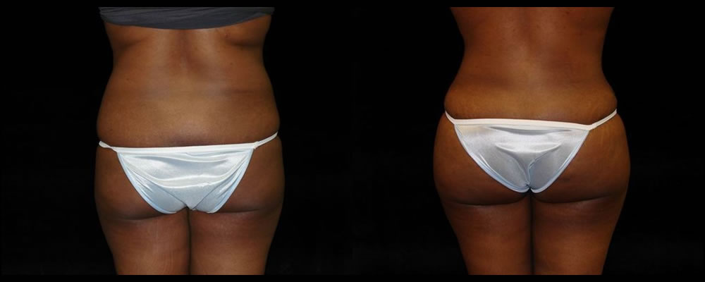 Brazilian Butt Lift Before & After Patient #654