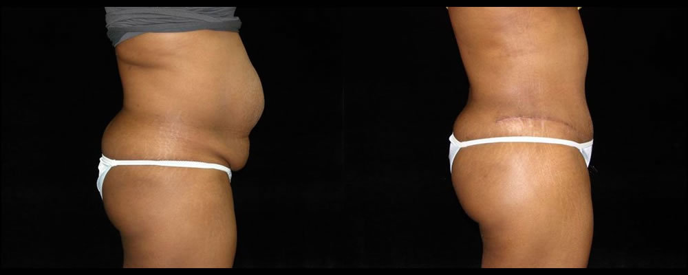 Brazilian Butt Lift Before & After Patient #654