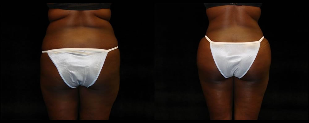 Brazilian Butt Lift Before & After Patient #650