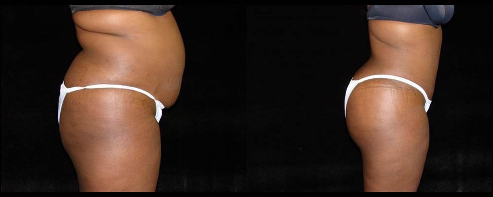 Brazilian Butt Lift Before & After Patient #650