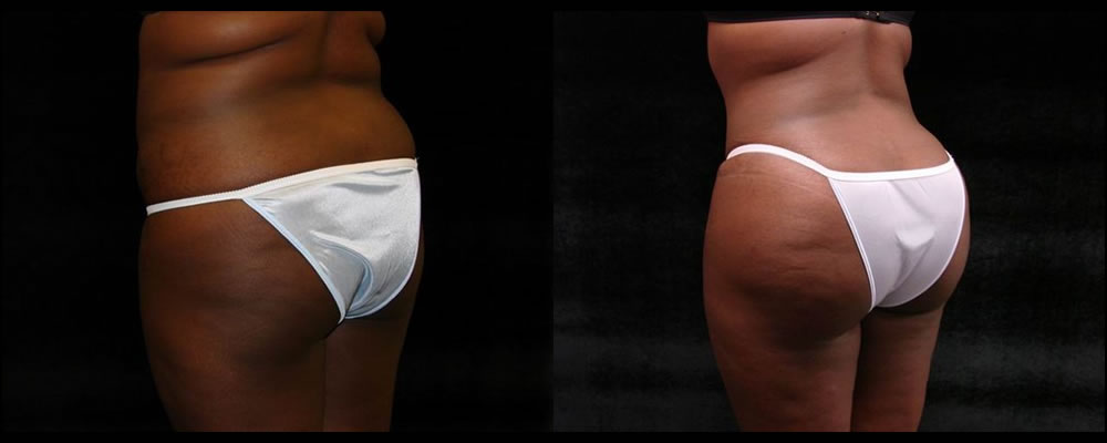 Brazilian Butt Lift Before & After Patient #650