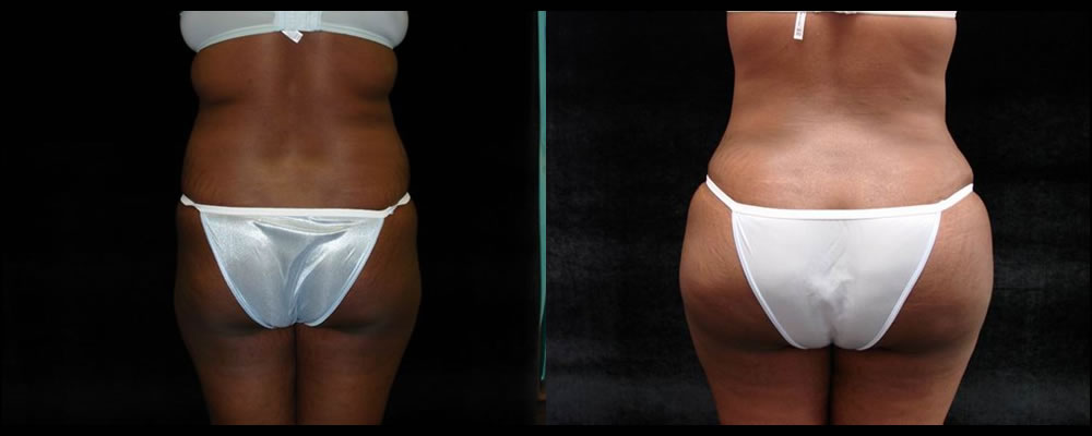 Brazilian Butt Lift Before & After Patient #646