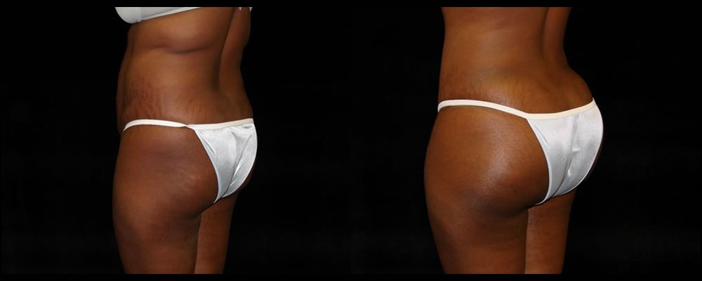 Brazilian Butt Lift Before & After Patient #646