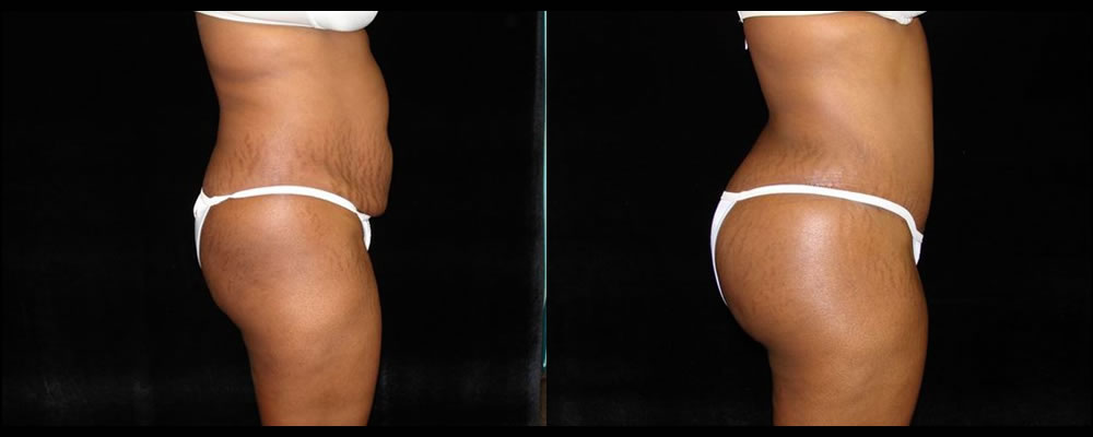 Brazilian Butt Lift Before & After Patient #646