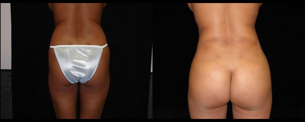 Brazilian Butt Lift Before & After Patient #642