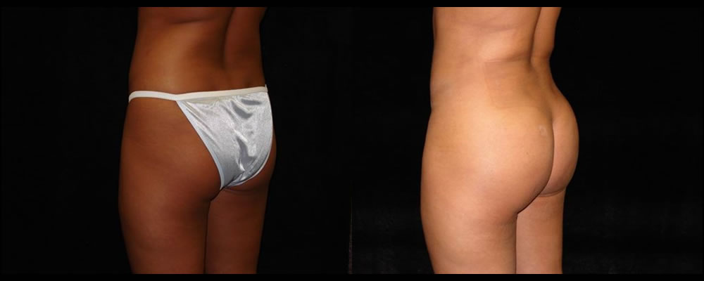 Brazilian Butt Lift Before & After Patient #642