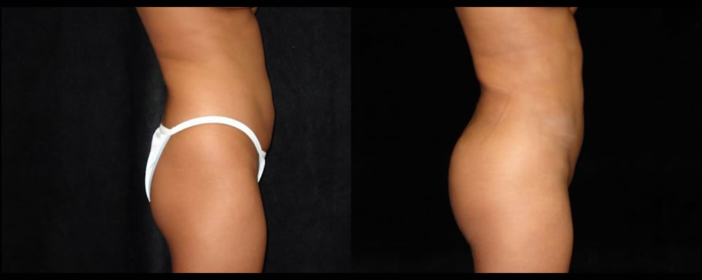 Brazilian Butt Lift Before & After Patient #642