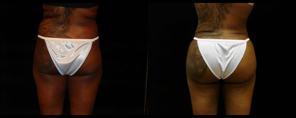 Brazilian Butt Lift Before & After Patient #638